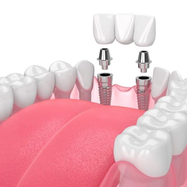 Why Preserving Jawbone Health Matters After Tooth Loss